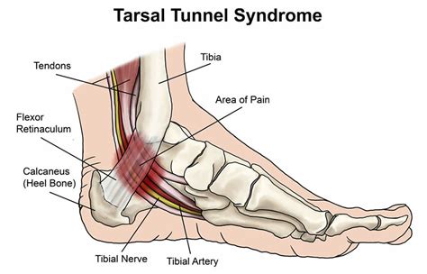 Tarsal Tunnel Syndrome - Symmetry Physical Therapy | Miami