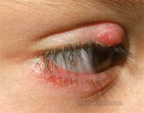 Stye Eye – Symptoms, Causes, Pictures, Treatment, Prevention