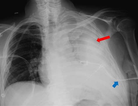 Chest X-ray showing complete opacification of the left hemithorax (red ...