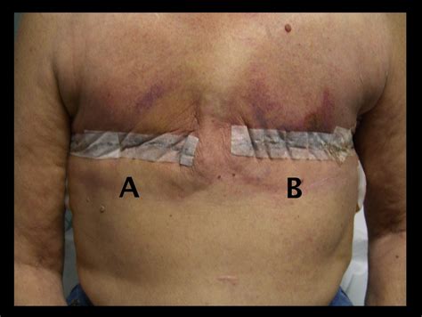 Traditional electrosurgery and a low thermal injury dissection device yield different outcomes ...