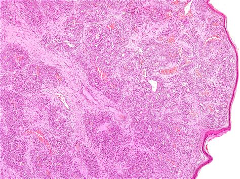 Capillary Hemangioma Lip Pathology Outlines | Sitelip.org