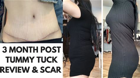 TUMMY TUCK SCAR AND BEFORE AND AFTER PICTURES // PLASTIC SURGERY UPDATE - YouTube