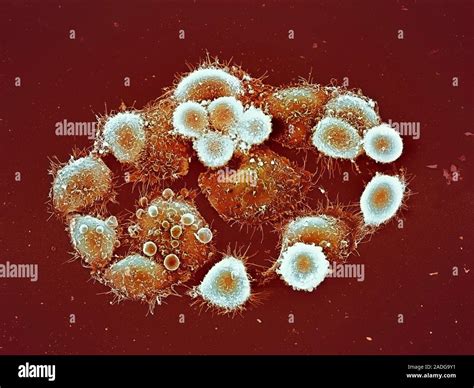 HeLa cells. Coloured scanning electron micrograph (SEM) of a colony of ...