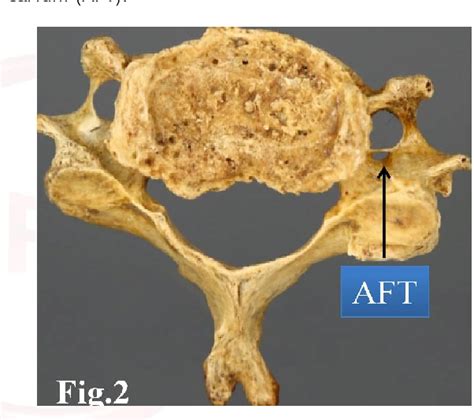 Figure 3 from ANATOMICAL VARIATIONS IN FORAMEN TRANSVERSARIUM OF TYPICAL CERVICAL VERTEBRAE AND ...