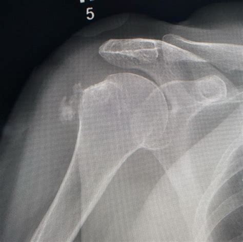 Calcific Bursitis! Hydroxyapatite deposition disease - Radiology - www.MedicalTalk.Net the Best ...