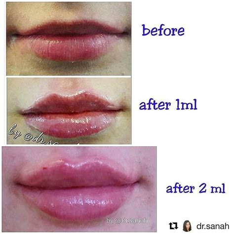 1 Ml Lip Filler Before And After