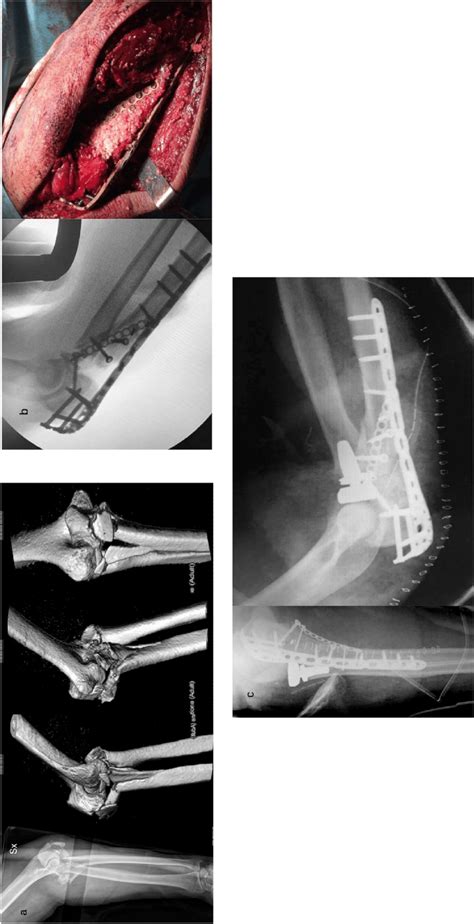 a) 3D-CT scan: high comminution of proximal ulna, sigmoid notch; large... | Download Scientific ...