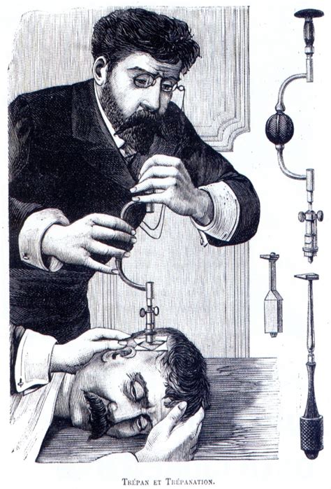 Trepanation | Anthropology, Culture, History | Pinterest | Therapy, Doors and The crazy