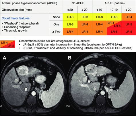 LI-RADS algorithm for application of major criteria (on the top). From... | Download Scientific ...