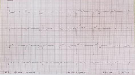 Third degree heart block: Causes, Symptoms, and Treatment Options