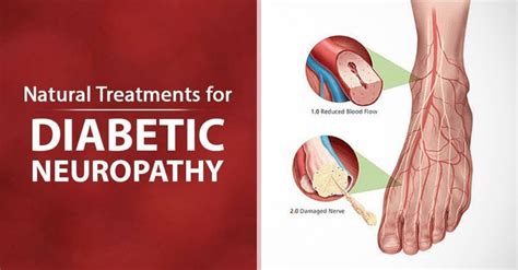 6 Natural Treatments for Diabetic Neuropathy