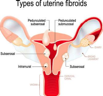 Uterine Fibroid Embolization | Tennessee Interventional & Imaging ...