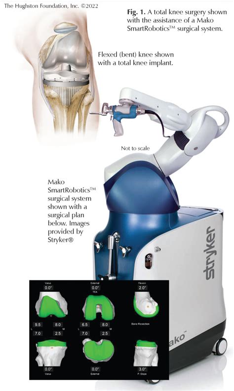 Robotic Total Knee Replacement: Questions for a Specialist - Hughston ...