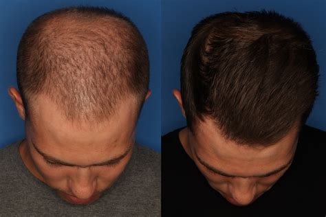 PRP for Men | Treatment for Hair Loss San Diego