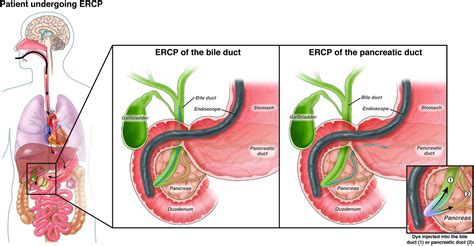 Endoscopic retrograde cholangiopancreatography (ERCP) - AGA GI Patient Center