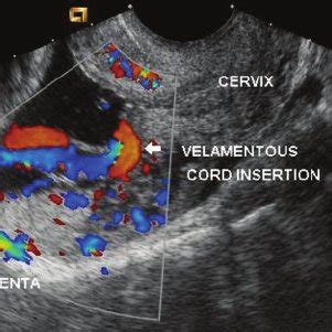 Illustration of vasa praevia type 1. | Download Scientific Diagram