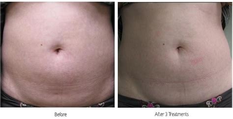 Lipodissolve in Phoenix, AZ | Suddenly Slimmer Med Spa