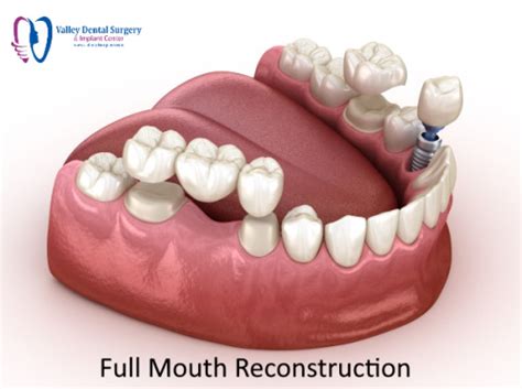 Full Mouth Reconstruction: Smile Makeover, Teeth Rehabilitation & Restoration | Valley Dental ...