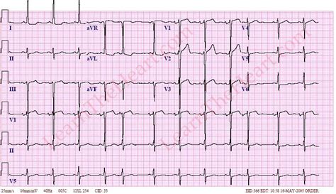 Premature Atrial Contractions Ecg