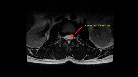 Herniated Disc Thoracic Mri