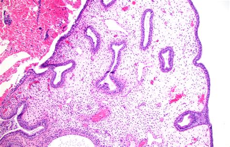 ENDOMETRIAL POLYP WITH A STALK PRESENTING IN THE CERVIX Looking Through ...