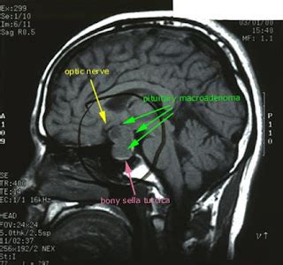 CT/MRI: Pituitary Macroadenoma