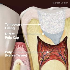 Less-Invasive Pulp Capping Could Save Your Tooth