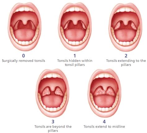 Tonsil Size Grading Scale and Tongue Position Grading System