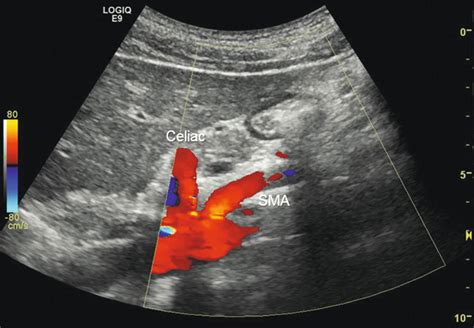 Mesenteric Arteries | Thoracic Key