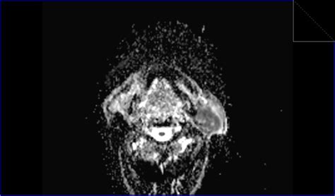 Warthin's tumor MRI