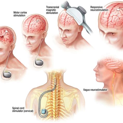 (PDF) Neurostimulation Devices for the Treatment of Neurologic Disorders