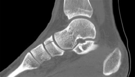 Navicular fracture - intlader