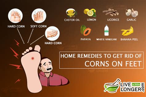 12 Best Home Remedies For Corns On Feet and Toes (Calluses)