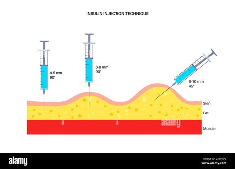 Insulin injection sites, illustration Stock Photo - Alamy