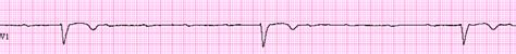 Ventricular Escape Rhythm - ECG Made Simple