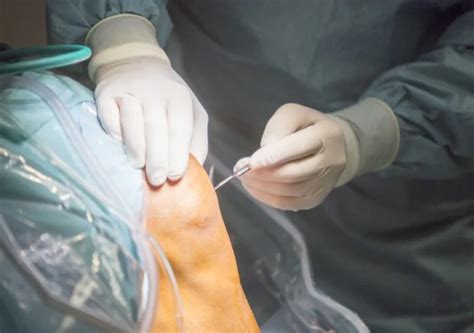 Patellar Tendon Surgery In 2024 - Dr. Pamela Mehta, San Jose