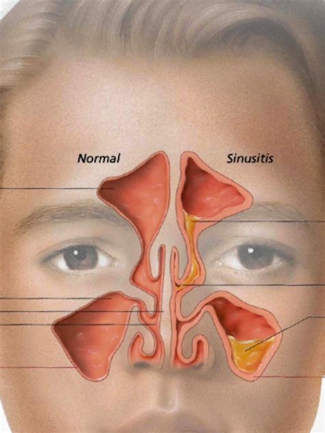 Sinusitis Specialist - Schaumburg, IL: Exhale Sinus and Facial Pain Center: Otolaryngologist