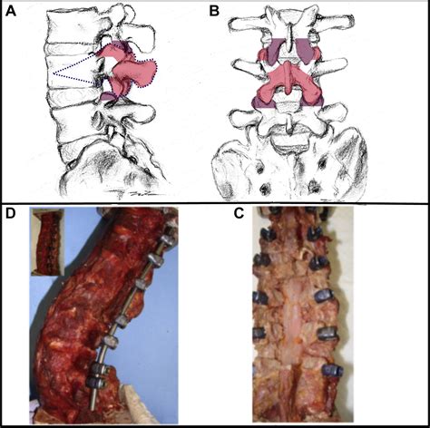 Additional sagittal correction can be obtained when using an expandable titanium interbody ...