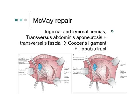 Types of Repair - Sports Hernia Specialist