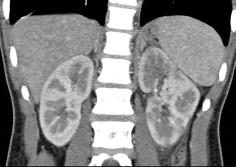 Acute Pyelonephritis with Patchy Nephrogram Best Seen on Late Phase Imaging as Well as Arterial ...