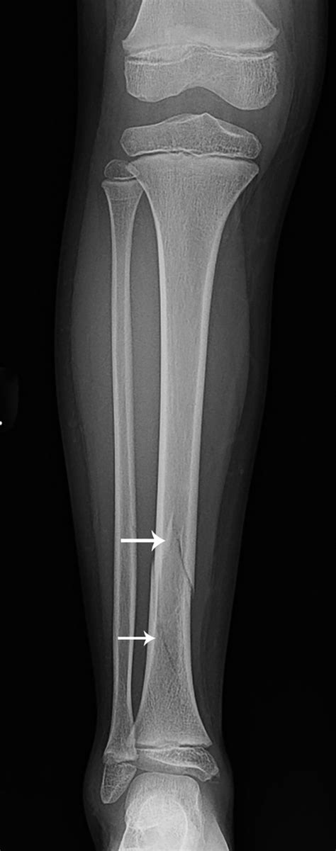 It’s the way you (don’t) walk: Fractures of the tibia and fibula | Radiology Key