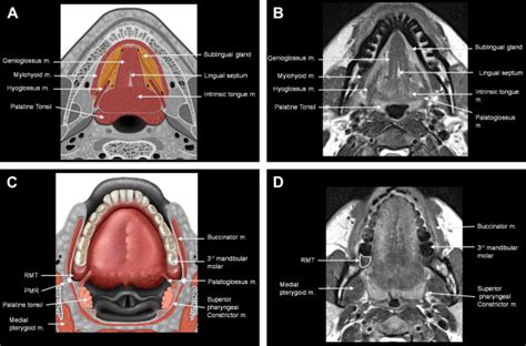 Pitfalls in the Staging of Cancer of Oral Cavity Cancer | Radiology Key