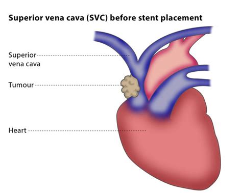 Vena cava stenting – CIRSE