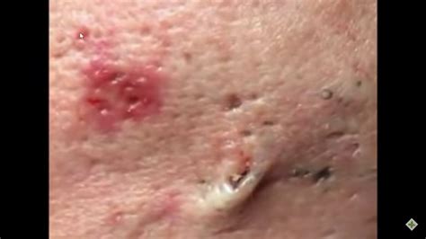 LARGE Blackheads Removal #003 - YouTube