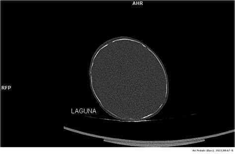 Neonatal lacunar skull as an isolated finding | Anales de Pediatría