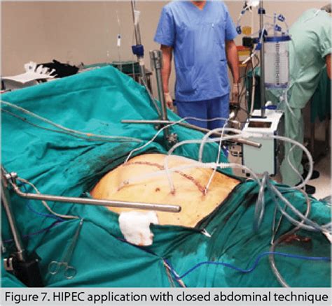 Figure 7 from Cytoreductive surgery (SRC) and hyperthermic ...