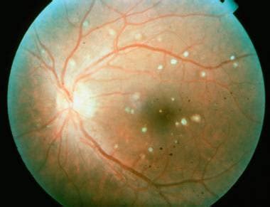 Multifocal Choroidopathy Syndromes: Overview, Multifocal Choroiditis, Acute Posterior Multifocal ...