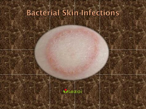 PPT - Bacterial Skin Infections : Causes, Symptoms, Treatment and ...