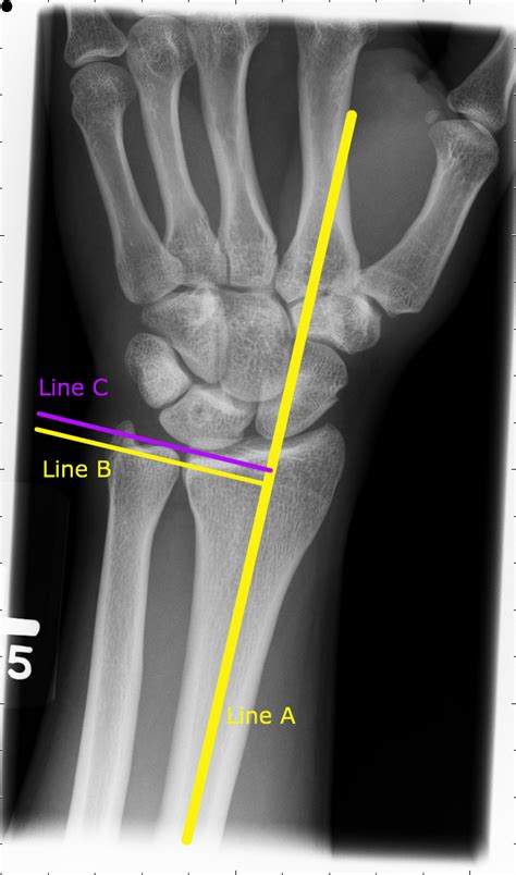 ULNAR VARIANCE | Sport Med School