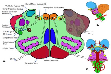 Structures affected in lateral medullary syndrome (A) Transverse view... | Download Scientific ...